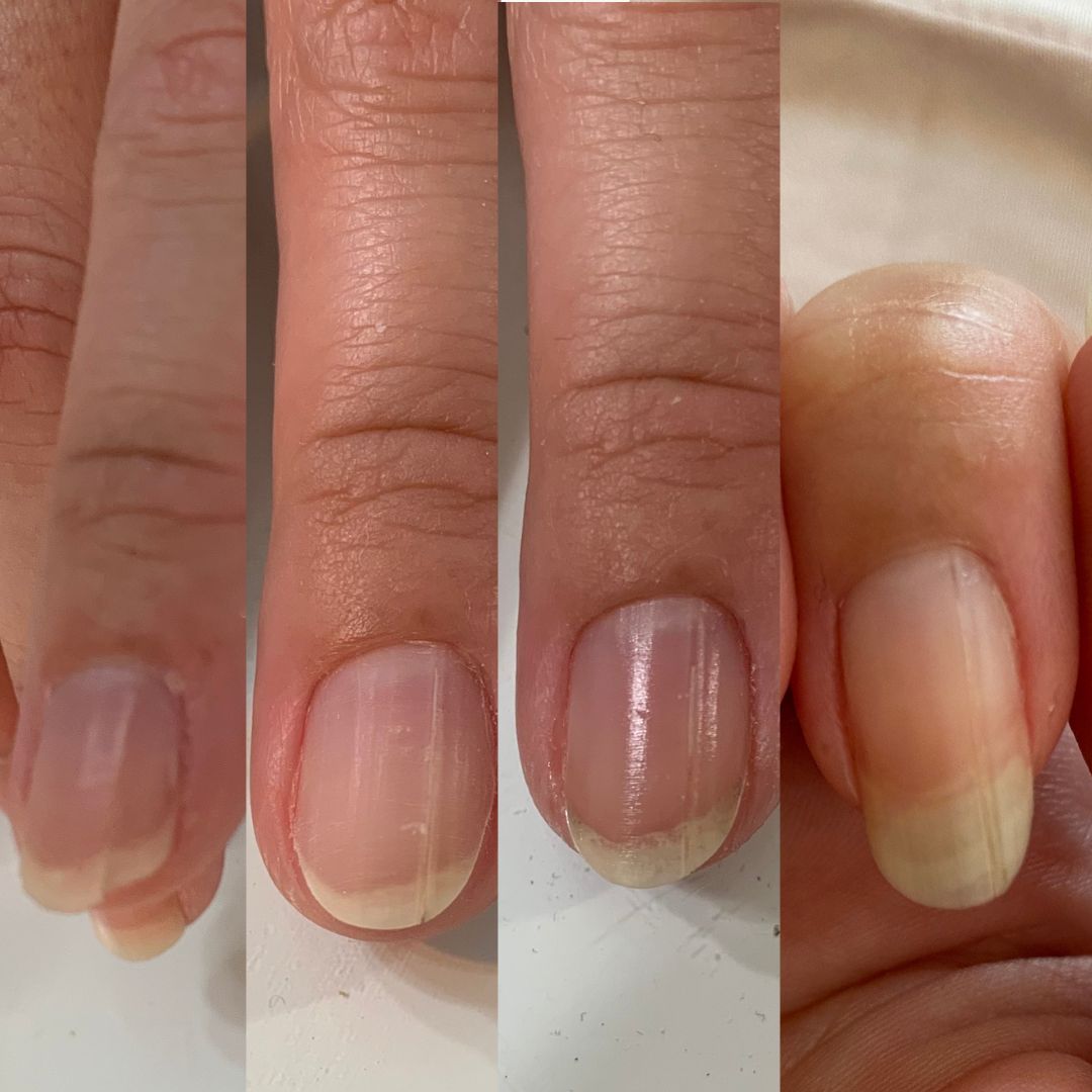 Ridges and splitting nails improvements