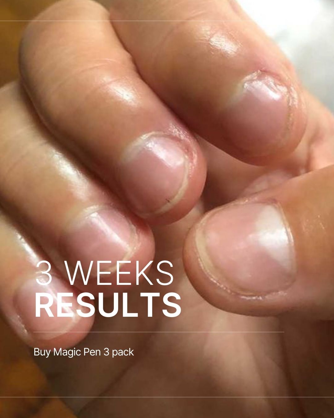 Magic Pen — Repair & Growth Nail Cream (Single Pen)
