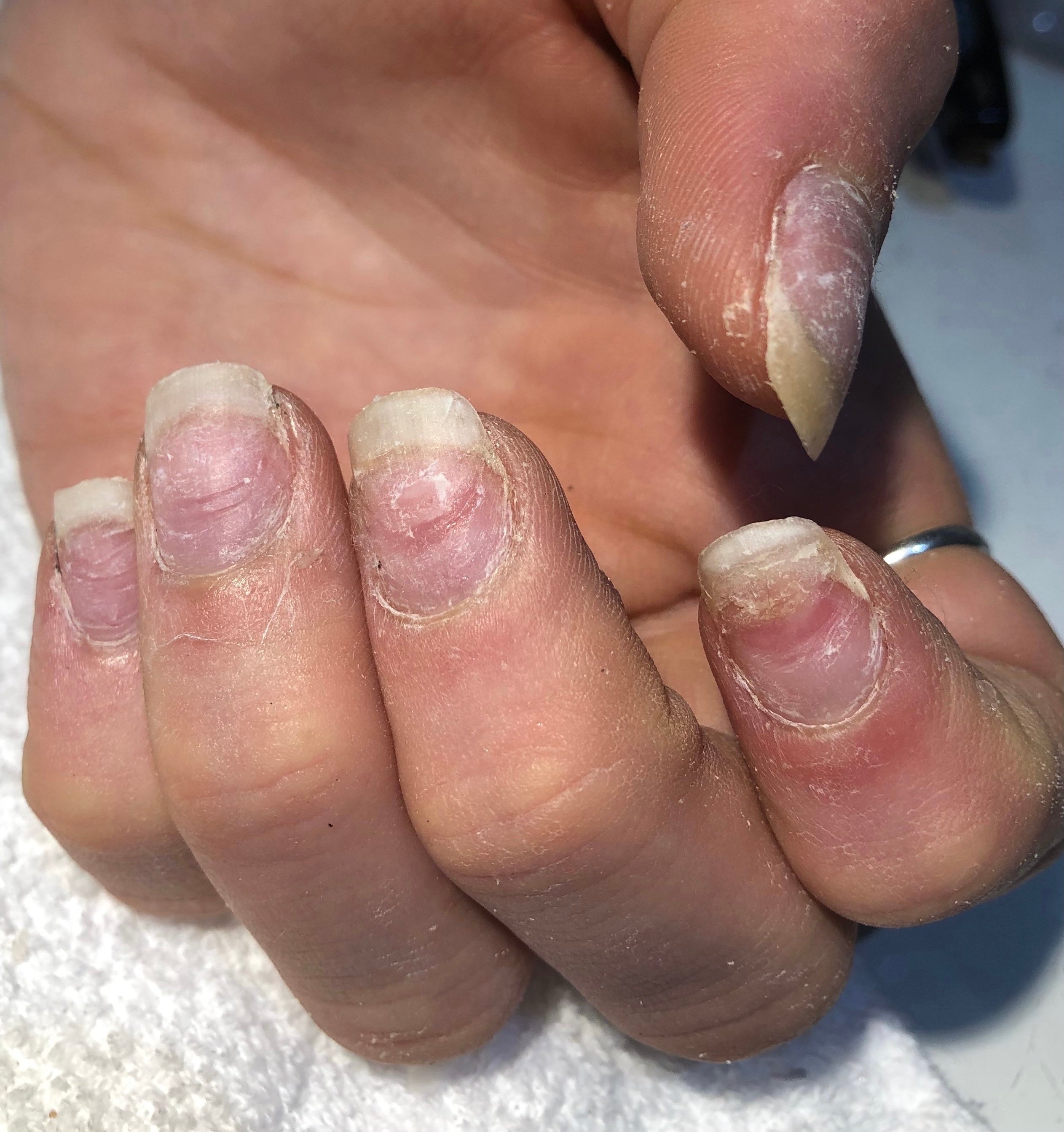 Close-up of a hand with worn and damaged nails on a textured surface.