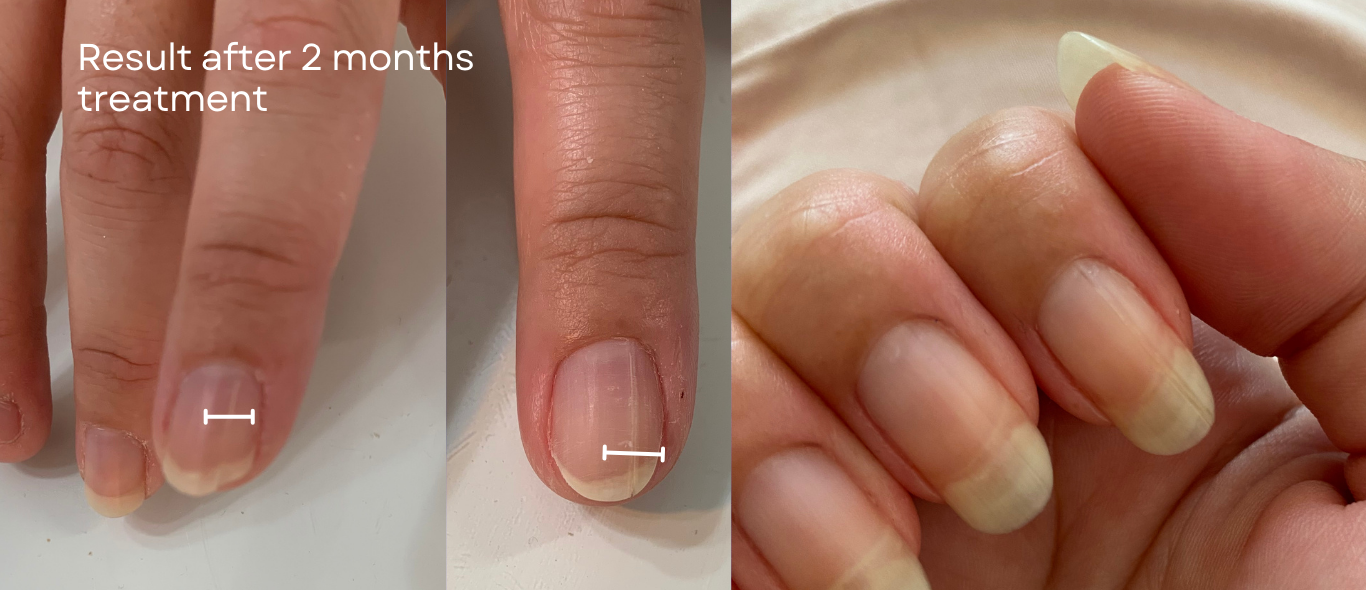 Magic Pen — Repair & Growth Nail Cream (Single Pen)